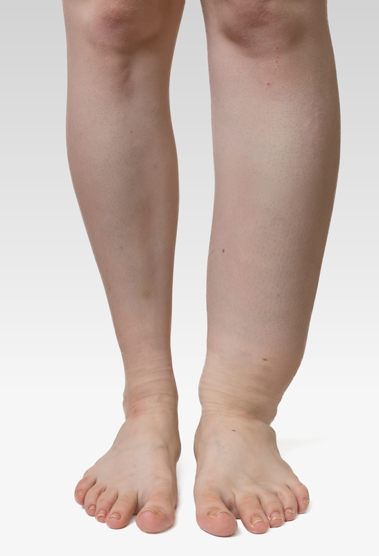 lymphedema in leg